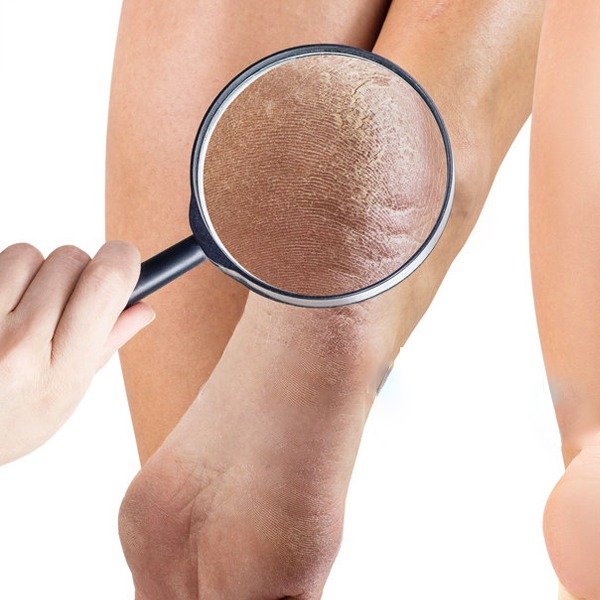 How to get rid of dry skin on feet: Causes and treatment - mamabella