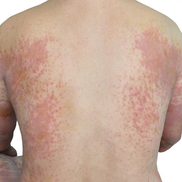 Eczema