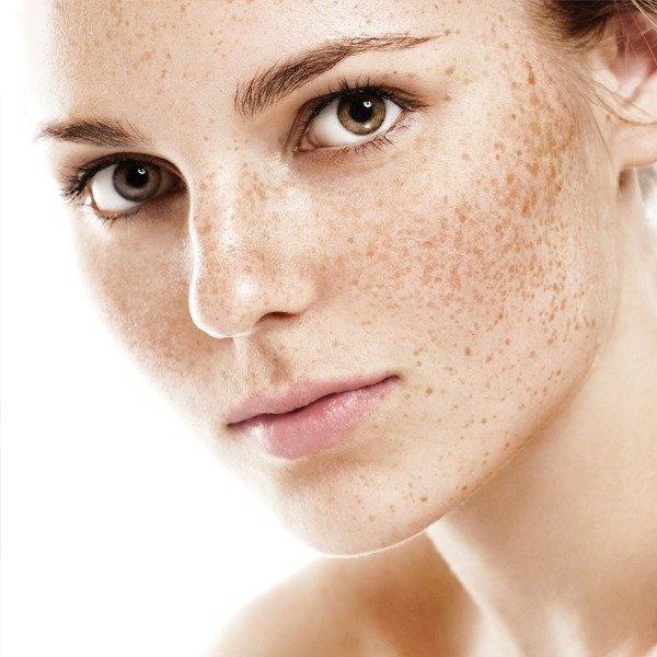 Freckles