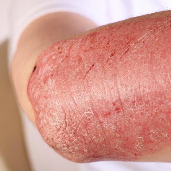 Psoriasis