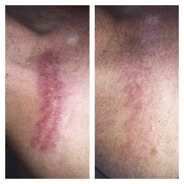 Before and after image of scars that have improved