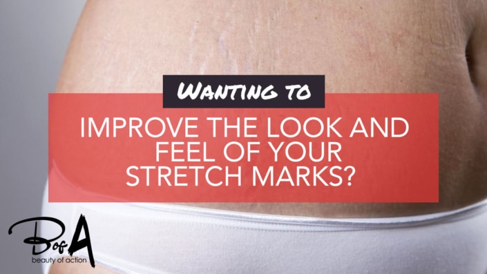 How Can I Minimise the Appearance of Stretch Marks? How Can I Minimise the Appearance of Stretch Marks?