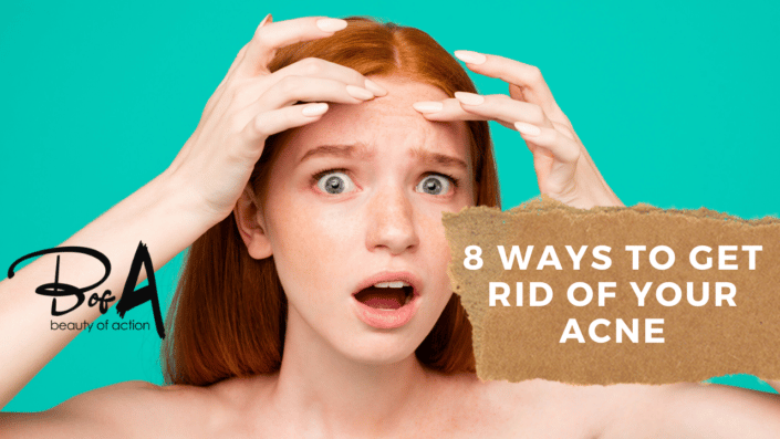 8 ways to get rid of your acne